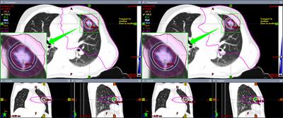 Selection Strategy of Jaw Tracking in VMAT Planning for Lung SBRT